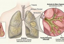 Mais de metade das pessoas com fibrose quística em Portugal já são adultas