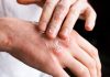 Dermatite Atópica afeta sono, saúde mental e vida social de milhões de pessoas