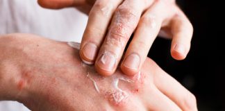 Dermatite Atópica afeta sono, saúde mental e vida social de milhões de pessoas